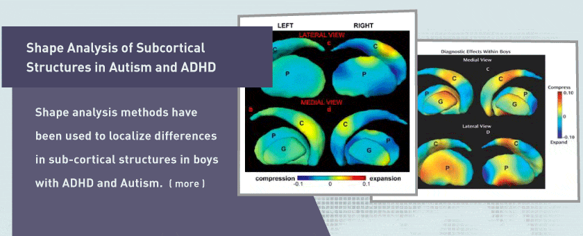 Shape Analysis of Subcortical Structures in Autism and ADHD